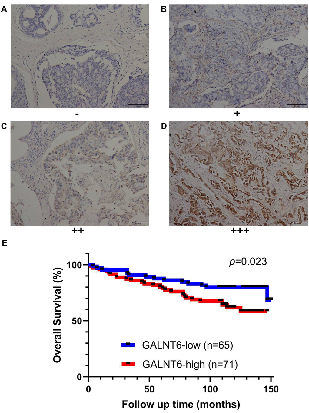 Effect of GALNT6 expression on breast cancer survival validated by IHC based on the breast cancer tissue microarray. (A–D) Representative images of negative, weak, moderate and strong were shown, respectively. Immunoreactivity was observed in the cytoplasm of cancer cells. (E) Kaplan-Meier analyses for the OS of breast patients with different levels of GALNT6.