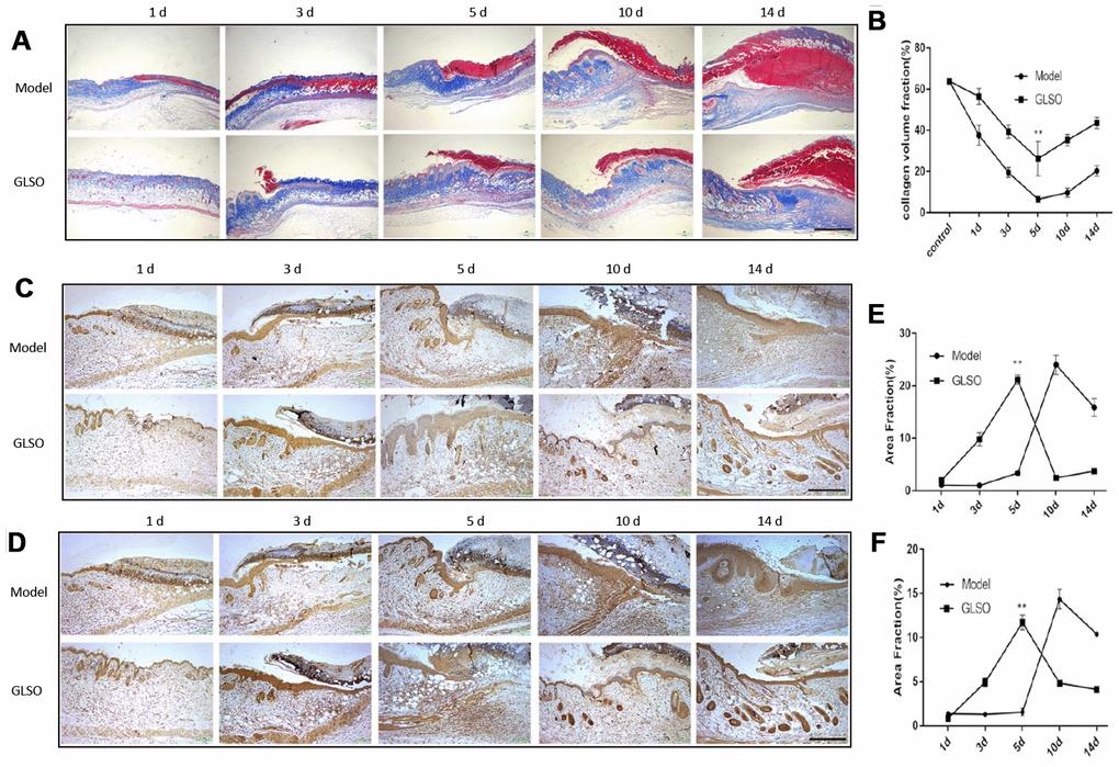 GLSO has an obvious impact on the collagen deposition on day 5. (A) Masson’s Trichrome was used to stain collagen deposition. Typical images of the stained tissue sections from the model group and GLSO group were from different healing time points under the microscope 40X (Scale bar = 1 mm). (B) Quantitation results of Masson’s Trichrome staining. (C, D) Immunohistochemical analysis of collagen I (C) and collagen III (D) at the murine wound edge from the model group and GLSO group under the microscope 100X (scale bar = 400 μm). (E, F) Quantitation results of collagen I (E) and collagen III (F) staining in comparison between the model group and GLSO group (n=3 each group).