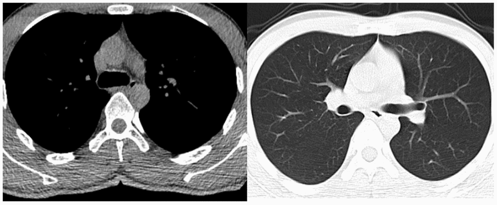 Preoperative chest CT examination of the patient.