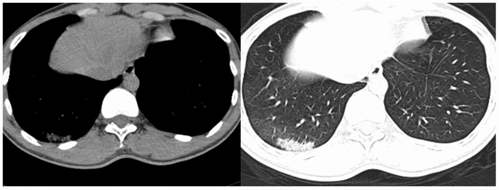 Chest CT examination of the patient on postoperative day 3.