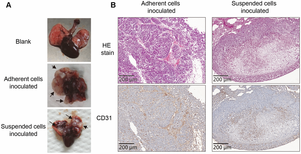 Loss of vasculogenic phenotype in the metastatic nodules formed by suspended melanoma cells. (A) Several white nodules were developed in the lungs of mice injected with either adherent or suspended melanoma cells. (B) HE staining and CD31 immunostaining showed vascular structures in the tumor nodules derived from adherent melanoma cells, but not seen in those from suspended melanoma cells.