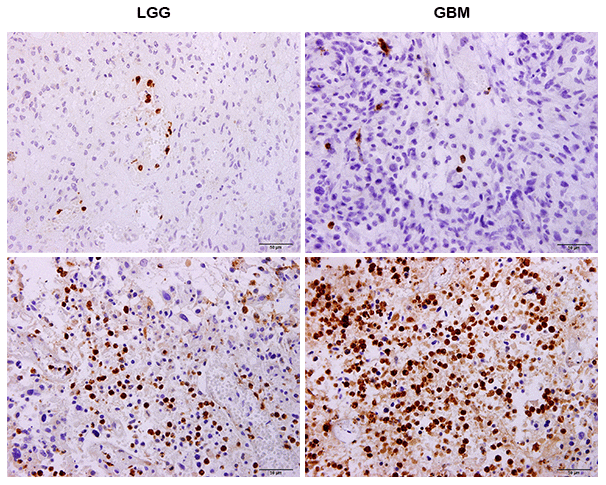 Immunohistochemistry (IHC) showing that neutrophils differently infiltrate tumors in both LGG and glioblastomas (GBMs).