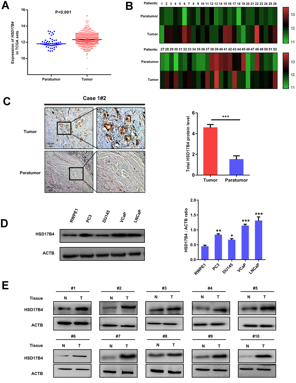 Expression of HSD17B4 is increased as PCa develops. (A) The expression of HSD17B4 was frequently upregulated in 498 PCa tissues (Tumor) compared with 52 adjacent normal prostate tissue samples (Paratumor) in the TCGA profile. (B) HSD17B4 expression was markedly increased in 52 paired PCa tissues (Tumor) and their adjacent normal tissues (Paratumor) in the TCGA profile. (C) Immunohistochemical staining of total HSD17B4 protein in tumor and adjacent tissues. A total of 10 PCa tissues and 10 adjacent normal prostate tissues were analyzed. Quantitative analysis of total HSD17B4 expression was performed by ImageJ. (D) Characterization of total HSD17B4 protein levels in PCa cell lines. Equal amounts of protein (20 μg) were immunoblotted for HSD17B4 and ACTB (loading control), as shown in the left panel. The intensities of total HSD17B4 protein are quantified in the right panel. (E) HSD17B4 is overexpressed in PCa tissues compared to expression in adjacent tissues. Human PCa samples each paired with cancerous tissue (designated as T) and adjacent normal tissue (designated as N) were lysed and directly subjected to western blotting. Ten pairs of samples clearly exhibited HSD17B4 overexpression in PCa tissues. Data are shown as the mean ± SD (n = 3) or typical photographs of one representative experiment. Similar results were obtained in three independent experiments. *p 