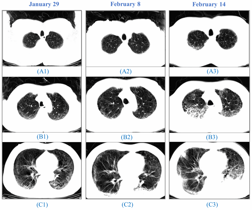 CT images from a 64-year-old man. A 64-year-old man, who had a fever and pneumonia, was suspected as the SARS-CoV-2 carrier on January 28 and confirmed on January 30. (A1), (B1) to (C1): On January 29, initial CT scans at the hospital admission showed multifocal ground-glass opacity (GGO) and reticulation, predominantly in the subpleural areas of both lungs. (A2), (B2) to (C2): On February 8, CT images indicated progressing GGOs. Newly-appeared patchy and core-like consolidation were visible in lower lobes of both lungs. The patient showed high fever, cough, blood in the sputum, reduced SpO2, and a sign of heart failure. (A3), (B3) to (C3): On February 14, CT images showed progressing lesion with multiple newly-appeared GGO and consolidation. Irregular interlobular septal thickening was observed in the upper lobe of the right lung. The patient passed away on February 15.