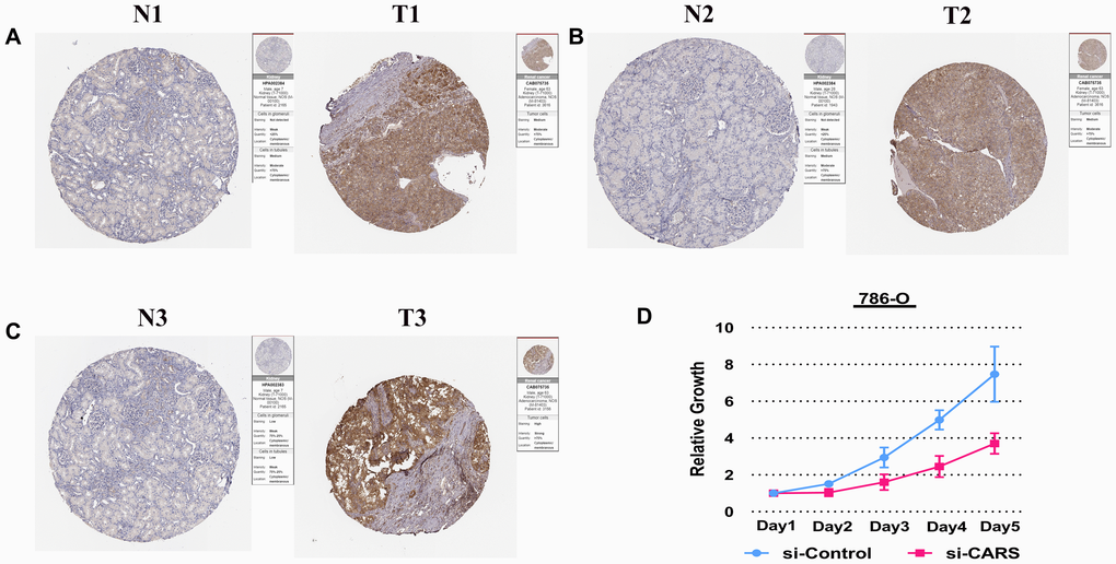 Experimental verification of CARS. (A–C) Immunohistochemical images from the HPA database show CARS protein expression in ccRCC (T) and normal kidney (N) tissues. (D) CCK8 assay results show the relative proliferation of si-control- and si-CARS-transfected 786-O cells. The data are shown as means ± S.D.