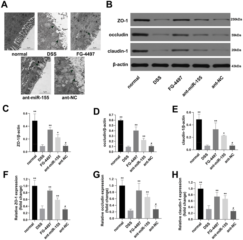 MiR-155 antagomir ameliorated intestinal barrier dysfunction in DSS-induced colitis. (A) Transmission electron microscopic (TEM) assay of colon specimens (magnification ×5000). The damages of epithelial cell villous and epithelial cells were significant in DSS and ant-NC group. (B) Western blotting analysis of TJ proteins (ZO-1, occludin, and claudin-1). (C–E) representative protein levels of ZO-1/β-actin, occludin/β-actin, and claudin-1/β-actin (n=3). (F–H) Relative mRNA of ZO-1, occludin, and claudin-1 in mice colonic tissue were measured by qPCR (n=5). Each bar represents mean ± SD, #P > 0.05, *P 