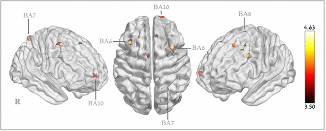 Brain regions with significant post hyperbaric oxygen therapy changes in cerebral blood flow.