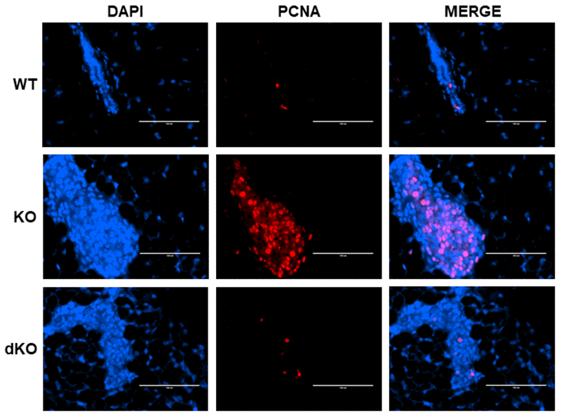 Proliferating Cell Nuclear Antigen (PCNA) increase in Cav-1 KO DCIS-like lesions secondary to estrogen treatment is inhibited by a homozygous STAT5a deletion. Mammary glands of estrogen-treated WT, Cav-1 KO, and Cav-1/STAT5a dKO mice were immunostained with an antibody recognizing proliferating cell nuclear antigen (PCNA). DAPI was used as a nuclear counterstain. The EVOS FL microscope was used to capture images at 40x objective with the DAPI and Texas Red light cubes (blue: DAPI immunostaining; red: PCNA immunostaining). Qualitatively, mammary glands lacking Cav-1 expression showed elevated PCNA expression upon stimulation with estrogen compared to WT counterparts. A STAT5a deletion in the Cav-1 KO mammary gland diminished PCNA expression to WT levels. For each experimental group, immunofluorescence was performed in triplicate on mammary glands derived from 3 independent mice.