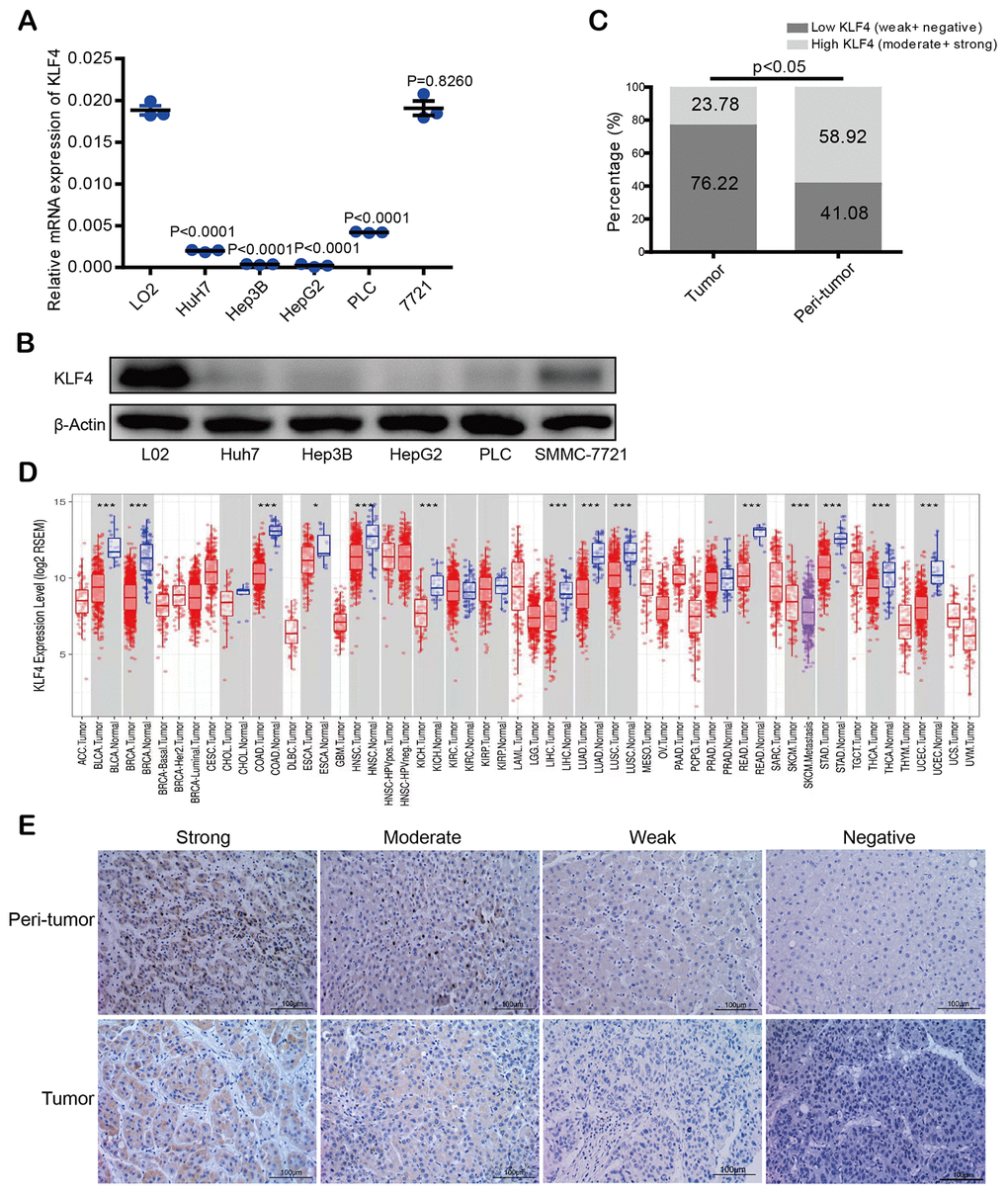 KLF4 expression in hepatocellular carcinoma (HCC) tissues and cell lines. (A) KLF4 expression was detected in the mRNA level among five HCC cell lines and one normal liver cell (L02). (B) KLF4 expression was detected in the protein level in six cell lines. The internal control was β-actin. (C) Immunohistochemical results were analyzed by chi-square test to compare the distribution of KLF4 in HCC tumors and adjacent tissues. (D) KLF4 expression was analyzed in tumor and para-tumorous tissues in TCGA tumors. (E) KLF4 expression was exhibited through characteristic photos of immunostaining in HCC tumor and para-tumorous tissues. Image scale= 100μm. P P P P 