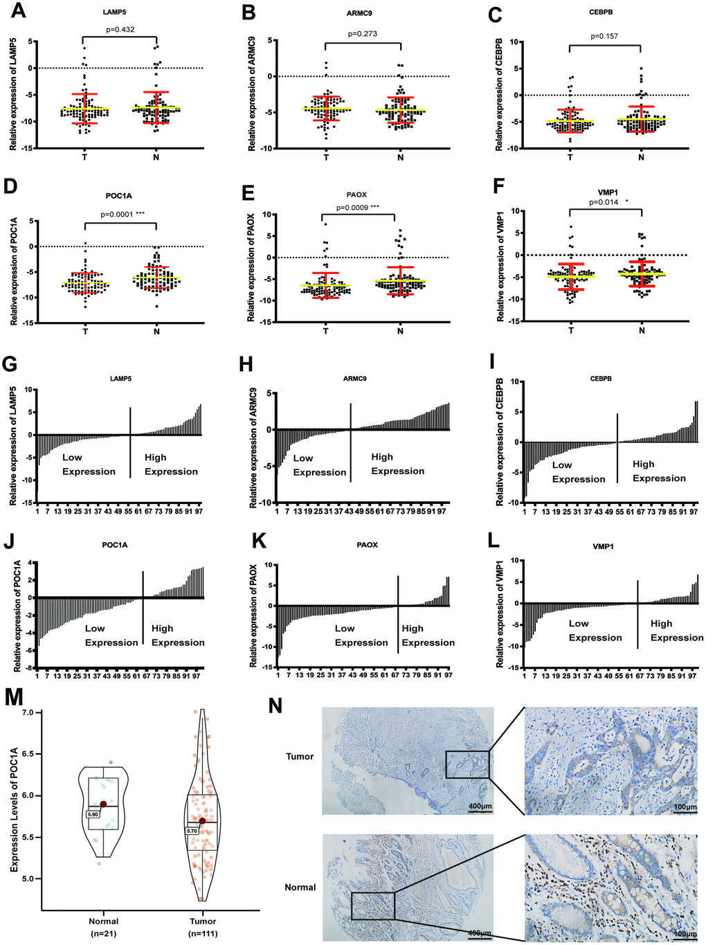 POC1A was a significant anti-tumor gene in gastric cancer. (A–F) Comparison of mRNA expression of 6 significant genes (LAMP5, CEBPB, ARMC9, POC1A, PAOX, VMP1) from LASSO regression analysis in tumor and adjacent tissues (n=101). (G–I). Ratio the mRNA expression of 6 genes comparing 2(-CT) in tumor tissues with 2(-CT) in matched normal tissues (n=101). (M) mRNA expression of POC1A in tumor (n=111) tissues was significantly higher than normal (n=21) tissues from GSE54129. (N) Intensity of immunohistochemistry staining of POC1A in normal tissue was higher than intensity in tumor tissue from the same patient.