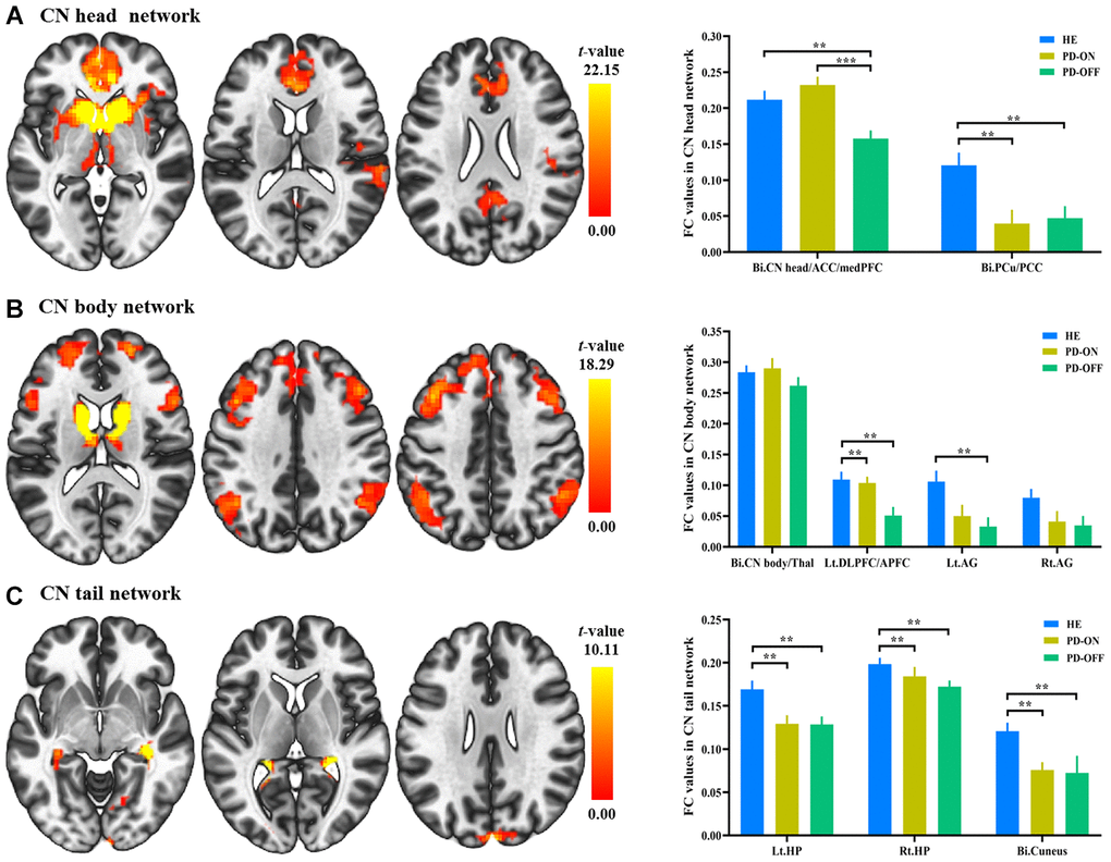 Functional connectivity (FC) changes in caudate nucleus (CN) subdivisions between PD and healthy elderly (HE), and between PD OFF-medication and ON-medication. (A) CN head network; (B) CN body network; (C) CN tail network. Results were illustrated at an uncorrected voxel-wise height threshold of p p **, p ***, p 