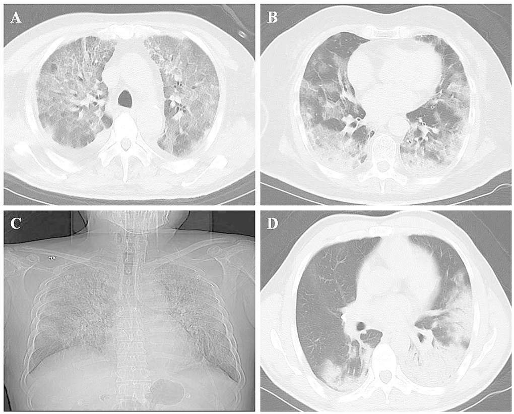 Chest imaging of patients with COVID-19. (A) Ground-glass opacity; (B) Lesion with ground-glass opacity and consolidation; (C) Lesion involving all lung lobes of both lungs; (D) Lesion involving the surrounding area of the bronchial blood vessel.