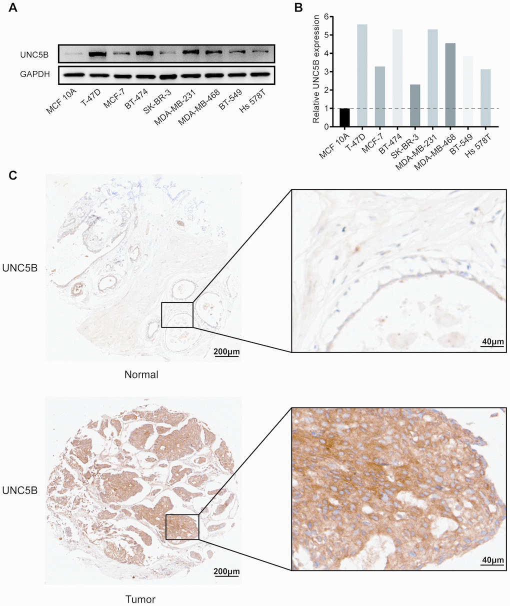 UNC5B protein expression in breast cancer (Western blot and IHC). (A) UNC5B expression in MCF 10A cells and diverse breast cancer cell lines. (B) The relative UNC5B protein expression in MCF 10A cells and diverse breast cancer cell lines. (C) Representative IHC image of UNC5B expression in breast cancer tissues and normal breast tissues.