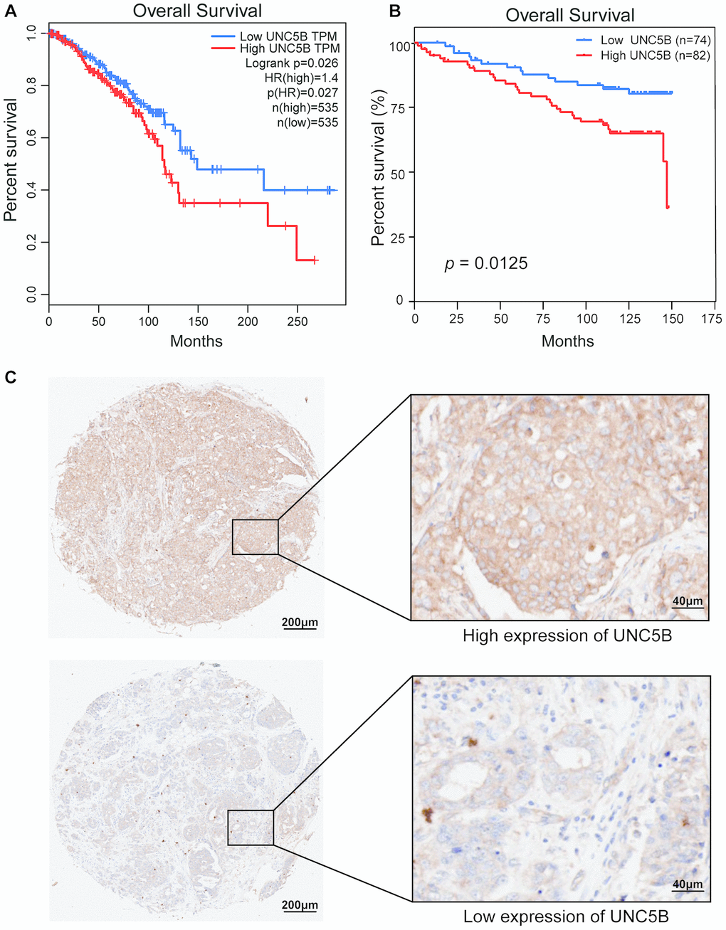 The prognostic value of UNC5B expression in breast cancer (GEPIA and IHC). (A) The prognostic value of UNC5B mRNA expression in breast cancer patients, analyzed by GEPIA. (B) The prognostic value of UNC5B protein expression in breast cancer patients. (C) Representative IHC images of high expression and low expression of UNC5B in breast cancer tissues.