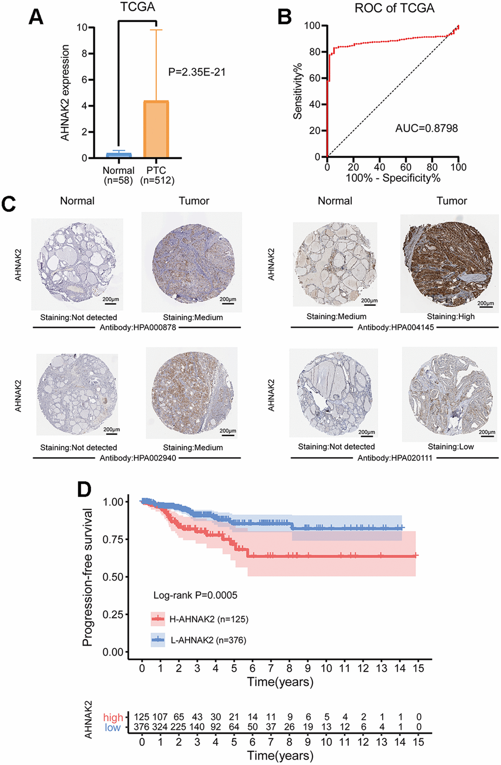 Diagnostic and prognostic value of AHNAK2 in PTC. (A) Comparison of AHNAK2 mRNA expression levels between PTC and normal tissues. (B) Diagnostic efficacy of the ROC curve of AHNAK2. (C) Comparison of immunohistochemistry images of AHNAK2 between PTC and normal thyroid tissues with four different AHNAK2 antibodies (HPA000878, HPA004145, HPA002940 and HPA020111) based on the Human Protein Atlas. (D) K-M survival analysis was performed to determine differences in PFS between the H-AHNAK2 and L-AHNAK2 groups.