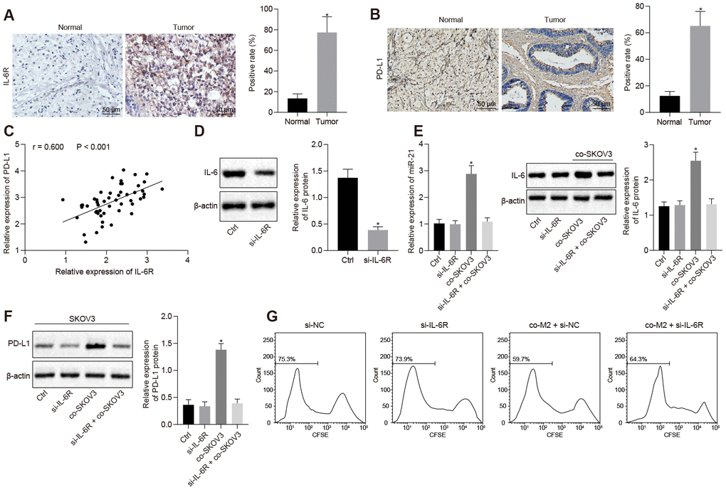 Overexpressed IL-6R in SKOV3 response to miR-21/IL-6 crosstalk elevates expression of PD-L1. (A, B) The expression of IL-6R and PD-L1 in ovarian cancer biopsy specimens analyzed by IHC. (C) correlation between IL-6R and PD-L1. (D) knock down efficiency of IL-6R assessed by western blotting. (E) expression of miR-21 after depletion of IL-6R determined by RT-qPCR. (F) change of PD-L1 after IL-6R silencing assessed by Western blotting analysis. (G) proliferation of T cells after inhibition of IL-6R analyzed by flow cytometry. * p vs. control or normal. Statistical comparisons were performed using unpaired t test when only two groups were compared or by Tukey’s test-corrected one-way ANOVA with when more than two groups were compared.