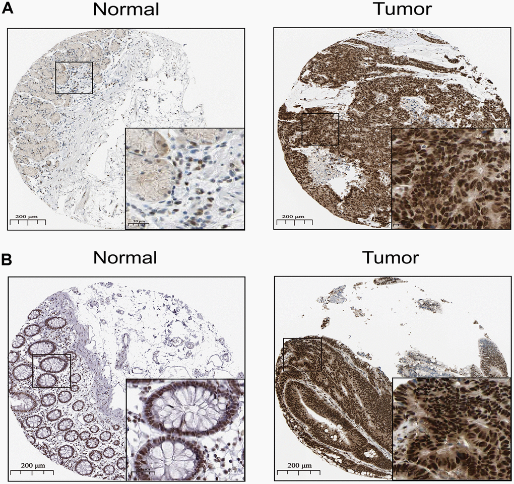 The distribution of SNAI1 in cancer. (A, B) Representative IHC images of SNAI1 expression in normal stomach tissues, stomach cancer tissues(A), normal tissues, and colorectal cancer tissues (B).