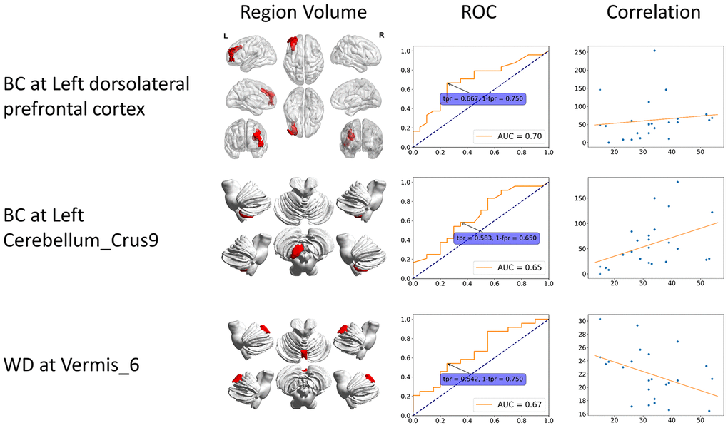 Static specific significant features. These features can only be identified from static functional connectivity. The 3D region volume was shown, as well as the ROC curve and correlation with clinical scores. The correlation is between clinical score (x-axis) and features (y-axis). BC: betweenness centrality; CCFS: clustering coefficient; LE: local efficiency; WD: weighted degree.