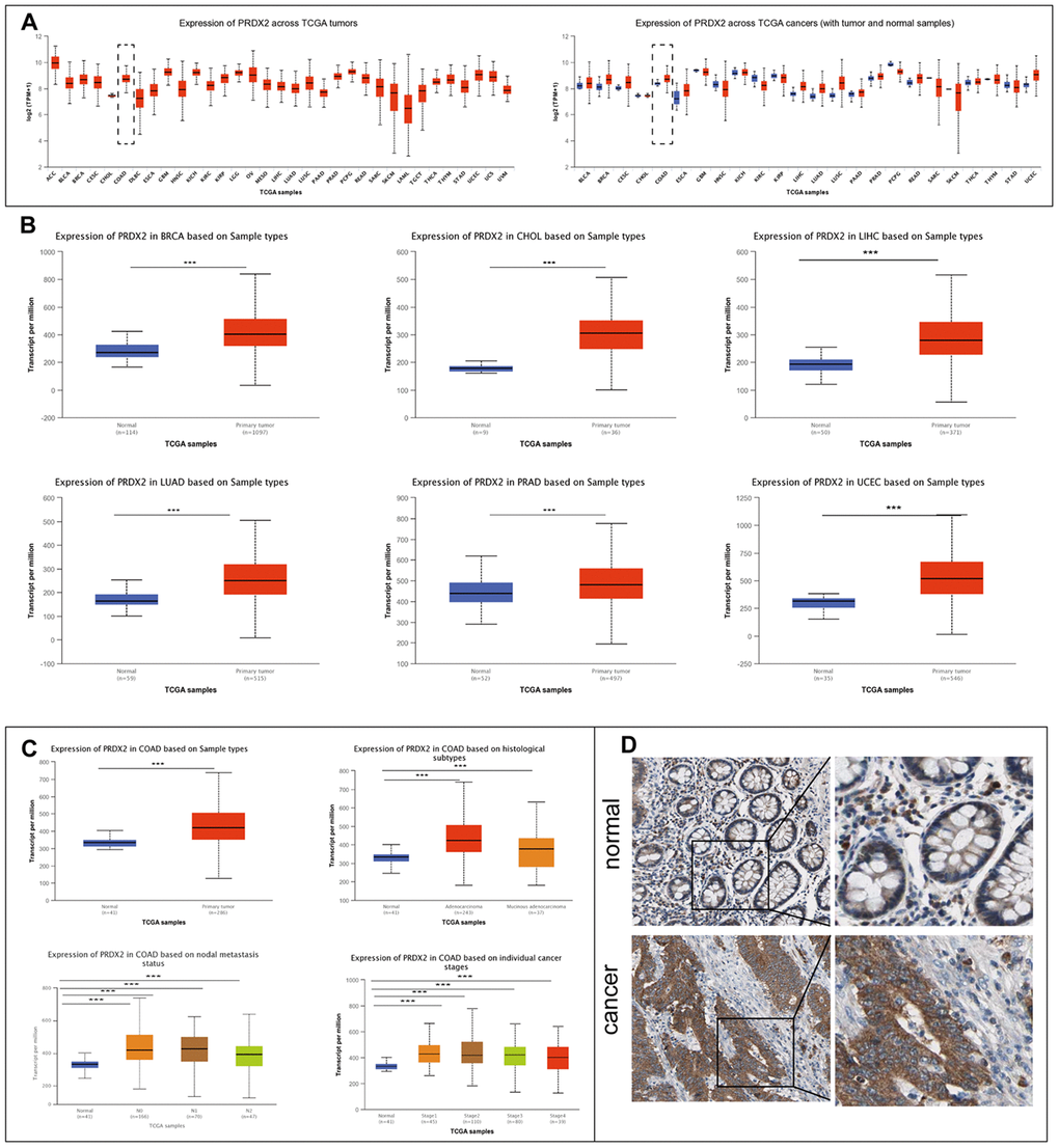 PRDX2 is upregulated in a variety of cancers, including CRC. (A) Expression of PRDX2 across TCGA tumors. Left panel: absolute expression values; right panel; expression in tumor versus normal samples. (B) Analysis of PRDX2 mRNA expression levels in normal and primary tumor tissues for breast invasive carcinoma (BRCA), cholangiocarcinoma (CHOC), liver hepatocellular carcinoma (LIHC), lung adenocarcinoma (LUAD), prostate adenocarcinoma (PRAD) and uterine corpus endometrial carcinoma (UCEC). (C) Analysis of PRDX2 mRNA expression levels between COAD and colon tissue according to histological subtypes, metastasis status, and individual cancer stages using the TCGA database through the UALCAN website. (D) Representative IHC photo images of PRDX2 protein expression in CRC tissues and normal colon tissues from The Human Protein Atlas website. ***P 