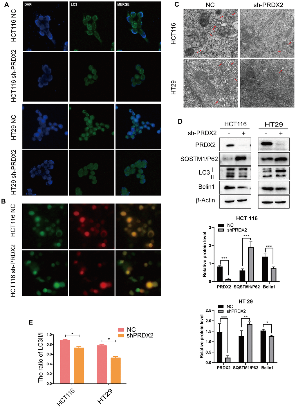 Knockdown of PRDX2 suppresses CRC cell autophagy flux. (A) Immunofluorescence images of GFP-labeled LC3B staining in sh-PRDX2 and control CRC cells. (B) NC and sh-PRDX2 cells were transfected with GFP-RFP-LC3 plasmids. (C) Sh-PRDX2 and control CRC cells were analyzed by transmission electron microscopy. Arrows indicate autophagosomes. (D) Western blot of autophagy-related proteins (LC3B, SQSTM1/P62, Beclin 1) in sh-PRDX2 and control CRC cells. (E) The ratio of LC3 II/I. The data are shown as the mean ± SD of three experiments. *P P P 