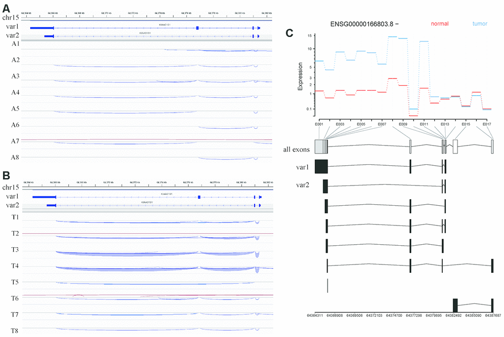 Analysis of KIAA0101 transcripts variant 1 and variant 2 based on RNA sequencing of our HCC specimens. (A) IGV visualization of splicing events in the genomic region covering the KIAA0101 transcript variants 1 and 2 in adjacent tissues. The top coordinate presents the location in the reference genome (GRch38), which ranges from 64,364 kb to 64,382 kb on chromosome 15. The exon usage of KIAA0101 transcripts variant1 and variant 2 is demonstrated below this coordinate. The splicing events in adjacent tissues A1-A8 are plotted and represented by curves that link the exons. The blue curve indicates splicing events on the minus strand, and the red curve indicates splicing events on the plus strand. (B) IGV visualization of splicing events in the genomic region covering the KIAA0101 transcript variants 1 and 2 in HCC tissues. The splicing events in HCC tissues T1-T8 are plotted. (C) Differential analysis of KIAA0101 (ENSG00000166803.8, - strand) exon usage in HCC and adjacent tissues. The red line indicates the average expression of different exons in the 8 normal tissue samples, and the blue line indicates those in the 8 tumor tissue samples. The horizontal axis demonstrates the position of all the exons from E001 to E017. The usage of these exons by different KIAA0101 transcripts is plotted below the horizontal axis, among which are variant 1 and variant 2. The bottom coordinate presents the corresponding reference genome coordinate.