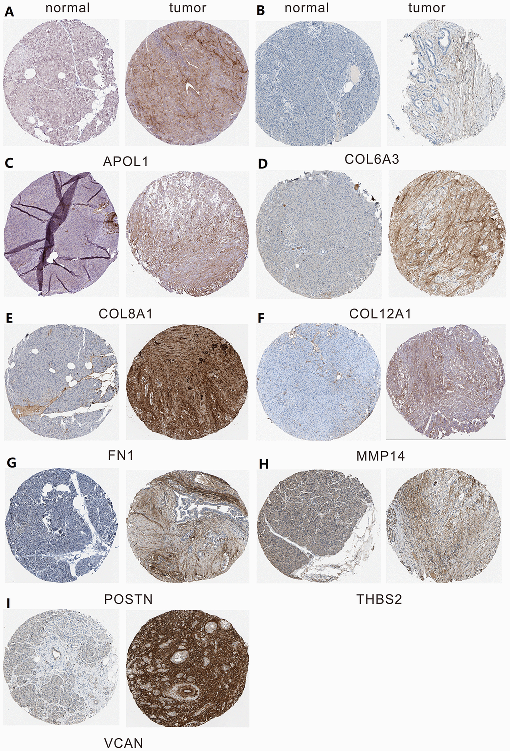 The protein expression level of hub genes in PDAC tissues and normal tissues was analyzed using immunohistochemical staining from Human Protein Atlas database. (A) Expression levels of APOL1 in pancreatic cancer. (B) Expression levels of COL6A3 in pancreatic cancer. (C) Expression levels of COL8A1 in pancreatic cancer. (D) Expression levels of COL12A1 in pancreatic cancer. (E) Expression levels of FN1 in pancreatic cancer. (F) Expression levels of MMP14 in pancreatic cancer. (G) Expression levels of POSTN in pancreatic cancer. (H) Expression levels of THBS2 in pancreatic cancer. (I) Expression levels of VCAN in pancreatic cancer.