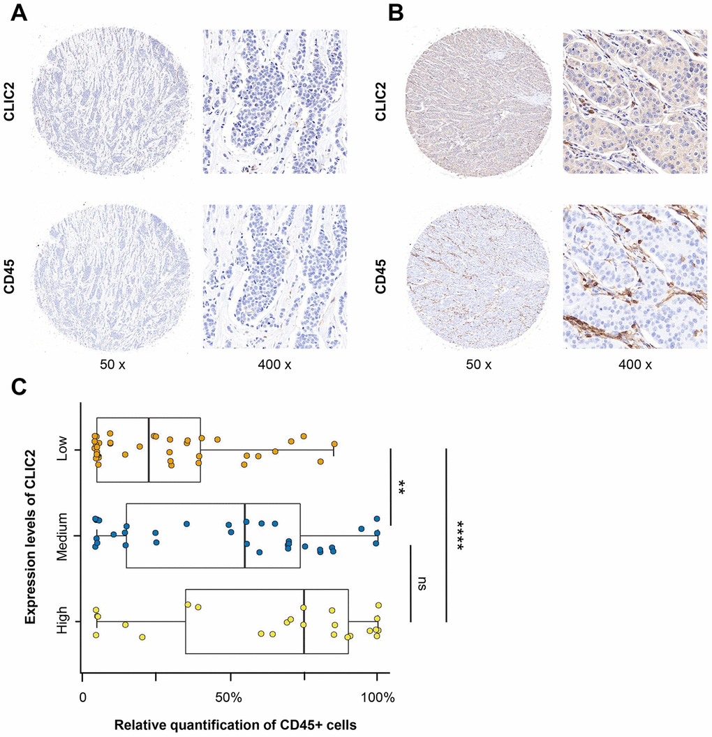 IHC analysis found that CD45+ cells were abundant in CLIC2 highly expressed tissue. (A) Low CLIC2 expression and low percentage of CD45+ cells. (B) High CLIC2 expression and high percentage of CD45+ cells. (C) Boxplot with scatter shows the different CD45+ cells percentage in tissue with different expression levels of CLIC2. ** p 