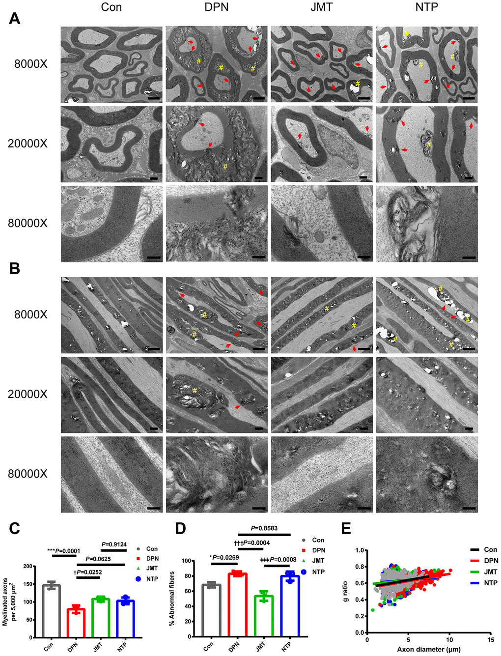 Ultrastructure and morphometry of sciatic nerves under transmission electron microscopy. Representative images of (A) cross-sections and (B) longitudinal sections of sciatic nerves from different groups at magnifications of 8000×, 20000×, and 80000×; scale bars, 2 μm, 500 nm, and 200 nm, respectively. Morphometric analyses of sciatic nerve showing (C) the number of myelinated axons per 5,000 μm2 and (D) the percentage of abnormal myelin fibers in different groups. Means ± SD; n = 3/group. (E) Quantification of g ratios for axons in different groups. n=632 axons from 3 normal control rats, n=525 axons from 3 distilled water-treated DPN rats, n=585 axons from JMT-treated DPN rats, n=544 axons from 3 NTP-treated DPN rats. ***p p vs. normal control group; †††p p vs. distilled water-treated DPN group; ‡‡‡p vs. JMT-treated DPN group. One-way ANOVA followed by Tukey’s multiple comparison test or Kruskal-Wallis test followed by Dunn’s multiple comparisons test. Pound signs (#) indicate onion-bulb and bubble form protrusions. Red arrows indicate lamellar separation between the axon and myelin sheath and demyelination.