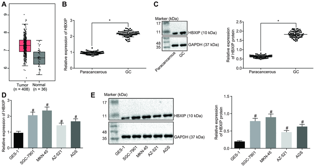 HBXIP expression pattern is upregulated in GC tissues and cell lines. (A) Expression pattern of HBXIP in tumor tissues and the matched normal tissues analyzed in the TCGA database. The red box on the left represents tumor samples and the gray box on the right represents normal samples. The numbers of tumor samples and normal samples are marked below. (B) HBXIP mRNA expression determined by RT-qPCR in GC and paracancerous tissues (n = 45), normalized to GAPDH, * p vs. the paracancerous tissues. (C) Representative Western blots of HBXIP protein and its quantitation in GC and paracancerous tissues (n = 45), normalized to GAPDH, * p vs. the paracancerous tissues. (D and E) HBXIP mRNA expression and protein expression patterns in GC cells and normal cells were measured by RT-qPCR (D) and Western blot analysis (E), normalized to GAPDH, # p vs. the GES-1 cell lines. The above data were measurement data, and expressed as mean ± standard deviation. Data in panels (B and C) were compared by paired t test and in panels (D and E) by one-way ANOVA with Tukey’s post hoc test. The cell experiment was repeated 3 times independently.