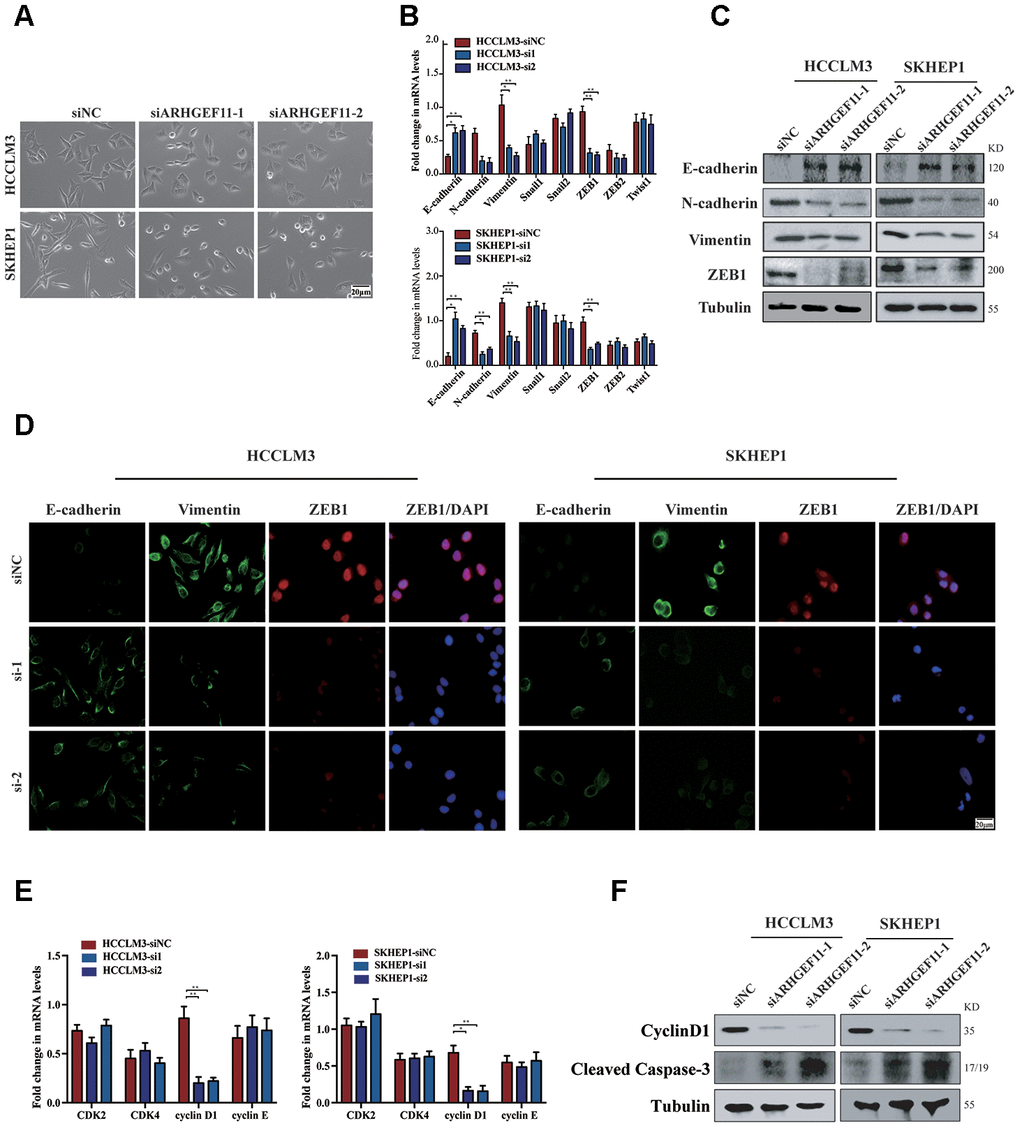 Knockdown of ARHGEF11 attenuates EMT, cell cycle progression and induces cell apoptosis via β-catenin-dependent way. (A) Micrographs of indicated cell clones. (B) The mRNA expression of a series of EMT markers and inducers in indicated cells. (C) Relative expression of E-cadherin, N-cadherin, Vimentin and ZEB1 detected by western blot in the indicated cells. (D) Immunofluorescence assay of E-cadherin, Vimentin, and ZEB1 expression in the indicated cells. The merged images show overlays of ZEB1 (red) and nuclear staining by DAPI (blue); scalebar: 20 mm. (E) The mRNA levels of CDK1, CDK2, cyclinD1 and cyclinE in indicated cells (F) Relative expression of cyclinD1 and Cleaved Caspase-3 detected by western blot in the indicated cells.