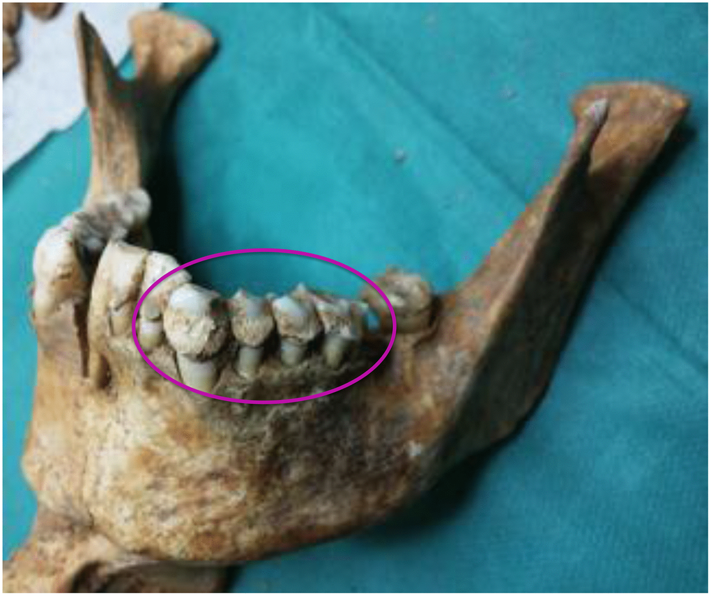 A mandible of one of the skulls examined. The circle indicates the abundance of calculus.