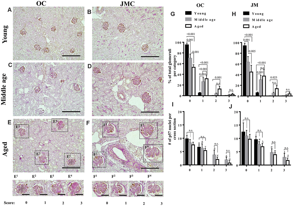 Glomerulosclerosis in aged PEC-PODO reporter mice. (A–F) Representative images of p57 stained (brown, nuclear) podocytes with periodic acid–Schiff staining (PAS) counterstaining from young (6 months) (A, B), middle age (14 months) (C, D) and aged (24 months) (E, F) mice. Glomeruli were divided into two compartments: outer cortex (OC) (A, C, E) and juxta-medullary cortex (JMC) (B, D, F). Small insets represent examples of OC glomeruli (E1–E4) and JMC glomeruli (F1–F4) for each scoring category that characterized the severity of injury: starting from 0 (no injury) to 3 (globally sclerotic glomeruli). (G) Graph of glomerular injury scores in OC. The highest percentage of uninjured glomeruli (score 0) was in young mice (black bars). Middle age mice (gray bars) showed a significantly higher percentage of injured glomeruli (score- 1, 2) and increase in the severity of injury (score-3). Aged mice (white bars) showed a significantly higher percentage of injured glomeruli (score-1,2), and an increase in the severity of injury (score-3) compared to young and middle age mice, while the percentage of uninjured glomeruli was significantly decreased in aged versus young and middle age mice. (H) Graph of glomerular injury scores in the JMC. The percentage of injured glomeruli (score-1, 2) was significantly higher in aged mice (white bars) compared to middle age (gray bars) and young (black bars) mice. The percentage of severely injured glomeruli (score-3) was increased but did not reach statistical significance. Middle age mice showed a significant increase in injured (score-1,2) and severely injured glomeruli (score-3) compared young mice. (I) Quantification of podocyte number in the OC. Podocyte number per cross section, identified by p57+ cells, showed a decreasing trend for middle age and aged mice compared to young mice for individual injury scores, but the differences were not statistically significant. Podocyte number was significantly lower for injured glomeruli (score-1,2,3) compared to uninjured glomeruli (score-0). (J) Quantification of podocyte number in the JMC. Podocyte number per cross section, identified by p57+cells was higher compared to OC and showed a trend decreasing trend for middle age and aged mice compared to young mice for individual injury scores, but the differences were not statistically significant. Podocyte number was significantly lower for injured glomeruli (score-1,2,3) compared to uninjured glomeruli (score-0).