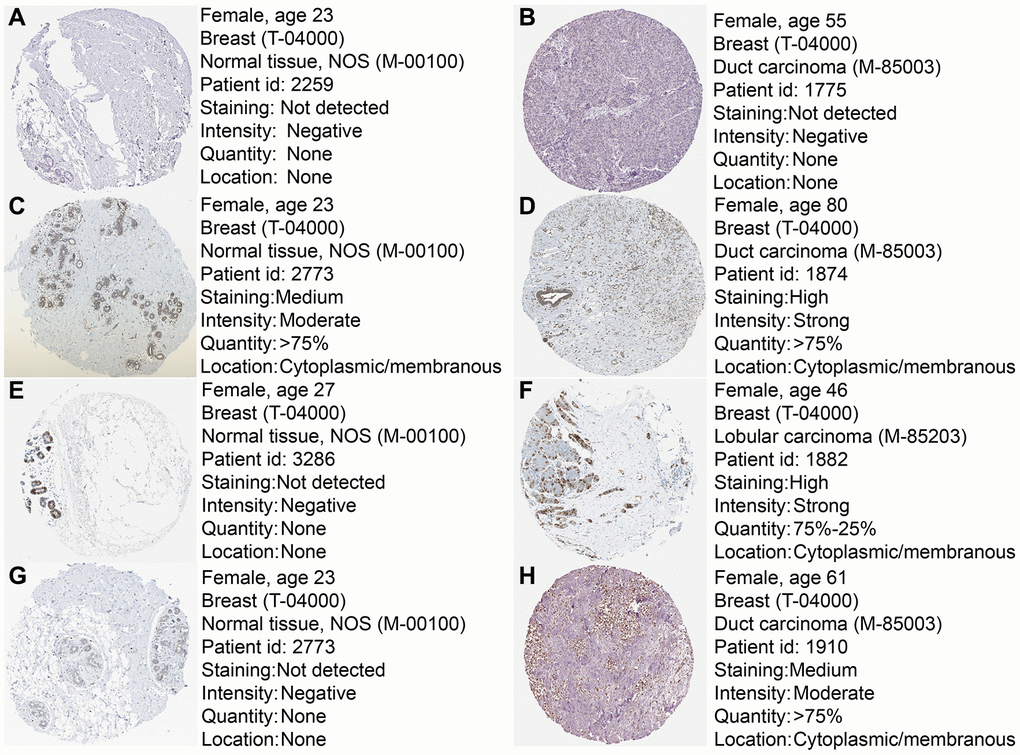 Immunohistochemistry of the four prognostic genes based on the Human Protein Atlas. (A) IHC staining of ALDH2 in normal tissue. (B) IHC staining of ALDH2 in tumor tissue. (C) IHC staining of PRKACB in normal tissue. (D) IHC staining of PRKACB in tumor tissue. (E) IHC staining of STMN1 in normal tissue. (F) IHC staining of STMN1 in tumor tissue. (G) IHC staining of ZNF292 in normal tissue. (H) IHC staining of ZNF292 in tumor tissue.