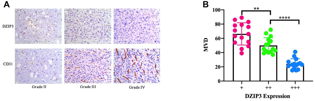 (A) IHC staining of DZIP3 and CD31 in different grades. (B) CD31-MVD is lower in samples with higher DZIP3 expression. **pp