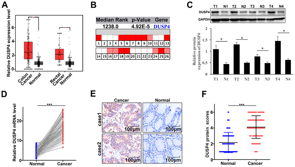 DUSP4 gene was highly expressed in colorectal cancer tissues. (A) mRNA abundance analysis of DUSP4 gene in GEPIA database. (B) mRNA abundance analysis of DUSP4 gene in oncomine. (C) Western blot analysis of normal tissues and colorectal cancer tissues. N: normal tissues; T: tumor tissues. GAPDH was employed as an internal reference. (D) qRT-PCR analysis of DUSP4 mRNA abundance in four colorectal cancer tissues and the paired normal tissues. (E and F) Immunohistochemical analysis of normal tissues and colorectal cancer tissues. *P