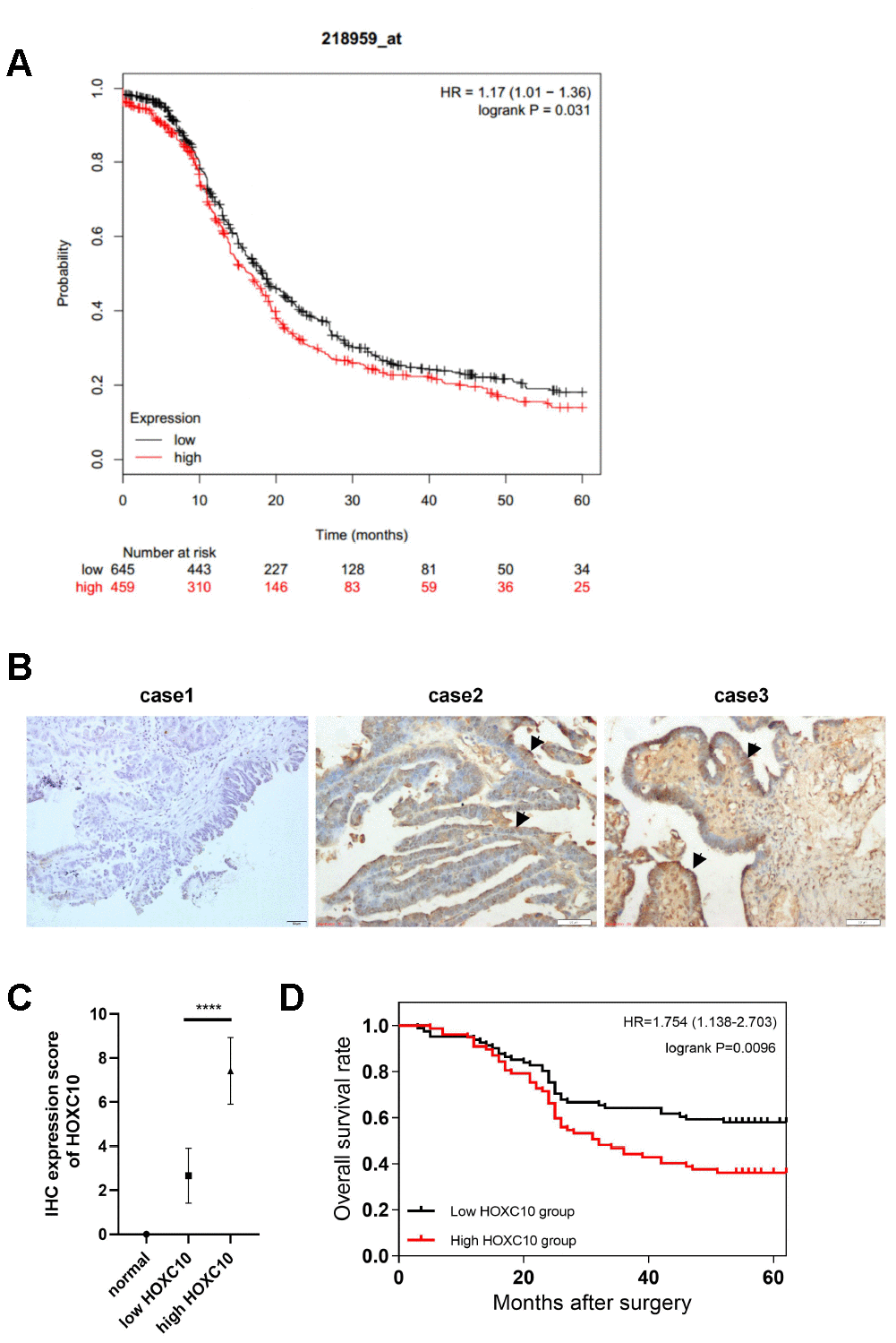 Overexpression of HOXC10 is associated with poor prognosis in OC patients. (A) Kaplan-Meier survival curves for OC patients (PFS; n = 1207). HR=1.17, P=0.031. (B) HOXC10 protein expression in normal ovarian tissues (case 1) and OC patient tissues (case 2, low expression of HOXC10; case 3, high expression of HOXC10) was assessed by IHC staining. Scale bars, 50 μm. (C) IHC positive rate scores for HOXC10 in normal tissues and each group of OC patient tissues. PD) Kaplan-Meier survival curves for 158 OC patients. HR=1.754, P=0.0096.