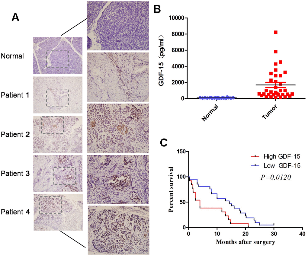 GDF-15 is aberrantly elevated in pancreatic cancer tissues and blood, and correlates with disease progression. (A) Detection of GDF-15 protein levels by immunohistochemistry (IHC) in 7 normal pancreatic tissues and 21 pancreatic cancer tissues. (B) GDF-15 protein expression was determined via Enzyme-Linked Immunosorbent Assay (ELISA) in 20 normal blood and 34 pancreatic cancer blood. (C) Kaplan-Meier curves for overall survival time of patients with pancreatic cancer after surgical resection. The high and low GDF-15 protein expression was based on the average value of GDF-15 protein expression in pancreatic cancer patients’ blood samples. ***P