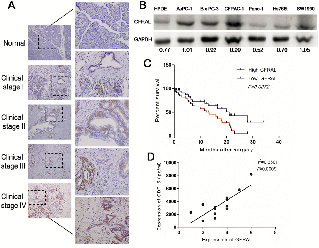 GFRAL is overexpressed in pancreatic cancer tissues and pancreatic cancer cell lines, and correlates with disease progression. (A) Detection of GFRAL protein levels by immunohistochemistry (IHC) in 117 pancreatic cancer tissues (clinical stages I, II, III, and IV) and 13 normal pancreatic tissues. (B) WB assay to detect GFRAL protein in different types of pancreatic cancer cell lines and normal pancreatic ductal epithelial cell line. (C) GFRAL expression correlates with overall survival time of patients with pancreatic cancer after surgical resection. (D) A positive relationship between GDF-15 and GFRAL protein was demonstrated in 13 pairs of pancreatic cancer blood and tissues based on Spearman’s correlation.