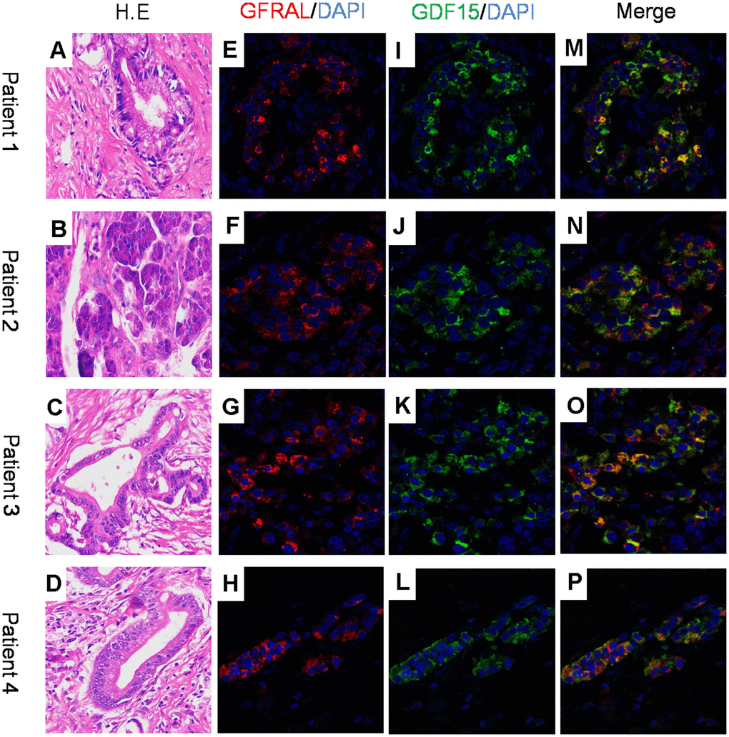 GFRAL and GDF-15 colocalize in human pancreatic cancer cells. (A–D) H.E images for 4 patient samples with histologically confirmed PDAC; (E–H) Immunofluorescence staining for GFRAL and nuclei counterstained with DAPI; (I–L) Immunofluorescence staining for GDF-15 and nuclei counterstained with DAPI; (M–P) Merged images of GFRAL, GDF-15, and DAPI staining.