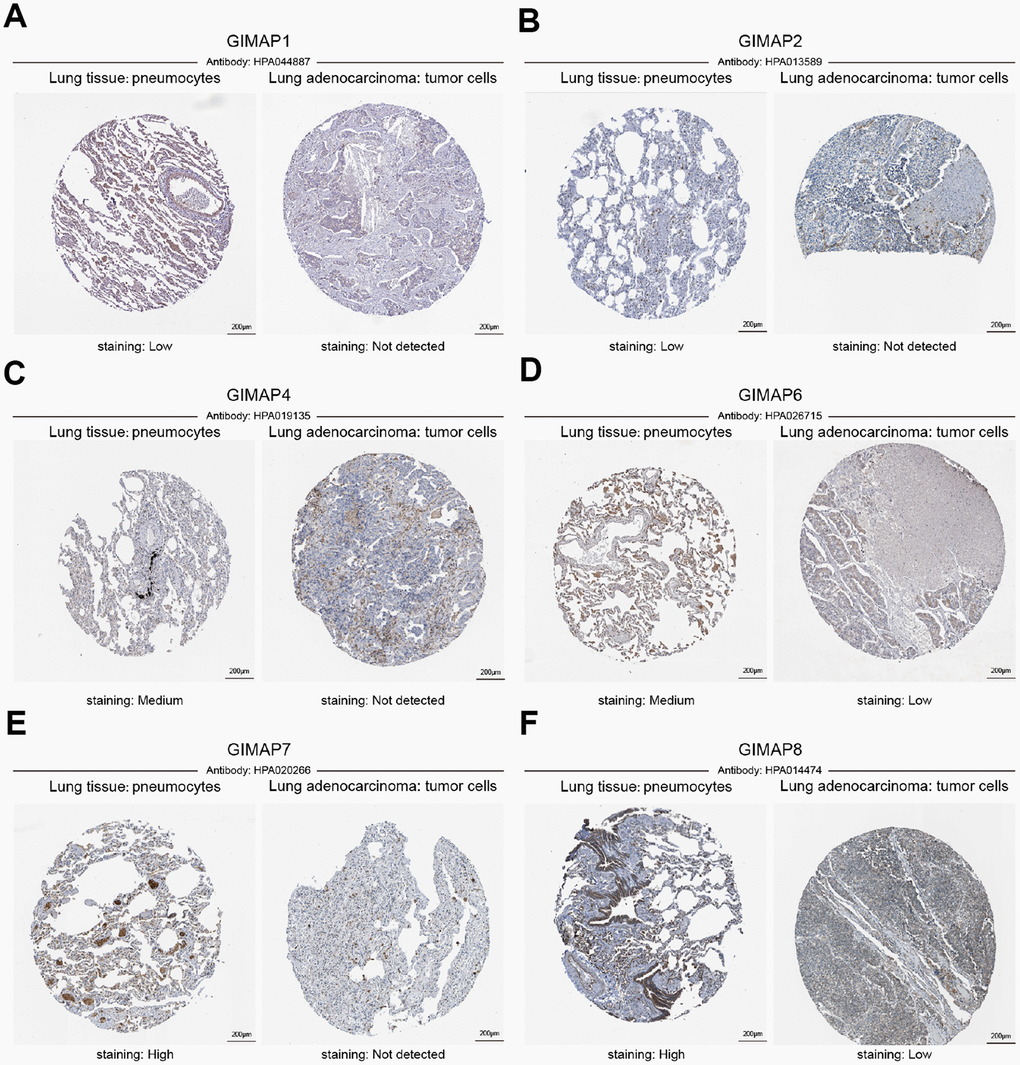 Representative immunohistochemistry images of distinct GIMAPs in LUAD tissues and normal lung tissues (Human Protein Atlas). GIMAP1/2 proteins were low expressed in normal lung tissues, whereas not expressions of them were observed in LUAD tissue (A, B). In addition, medium protein expressions of GIMAP4/6 were expressed in normal lung tissues, while not and low protein expressions of them were observed in LUAD tissue (C, D). Moreover, GIMAP7/8 would have high protein expressions in normal lung tissues compared with the LUAD tissue have not and low protein expressions (E, F).