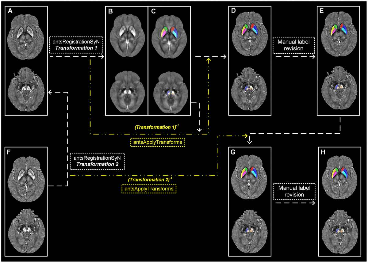 Asymmetrical nigral iron accumulation in Parkinson’s disease with motor