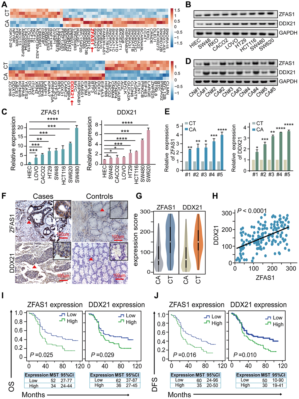 The association of lncRNA ZFAS1 and DDX21 expression in CRC cells and tissues. (A) The hierarchical clustering heat map illustrating the most differentially expressed lncRNAs and mRNAs in CRC patient tissues and their matched paired adjacent-tumor samples (n = 3), selected top 20 up-regulated or down-regulated genes (PB and C) The expression levels of lncRNA ZFAS1 and DDX21 in normal intestinal epithelial HIEC cell and CRC cells including SW480, SW620, SW48, HCT116, RKO, CACO2, LOVO, and HT29 cells detected by RT-PCR (B) and qPCR assays (C). GAPDH was selected as an internal control. (D and E) Representative data of lncRNA ZFAS1 and DDX21 expression in paired CRC and matched adjacent-tumor controls detected by RT-PCR and qPCR assays (5 representative data was shown). (F) ISH method detected the cellular localization and the expression of lncRNA ZFAS1, and IHC assay determined the DDX21 expression based on this included CRC patient tissues and matched tumor-adjacent controls (n = 157). The bar represents 100μm. (G) Violin charts displaying the expression levels of lncRNA ZFAS1 and DDX21 in this included CRC cohort. Nonparametric tests and median (interquartile range) were shown. (H) Linear correlation pattern showing a positive relationship between the expression of lncRNA ZFAS1 and DDX21. (I and J) Kaplan-Meier plot curves showing the association of lncRNA ZFAS1 high/low expression, DDX21 high/low expression with the OS (I) and DFS (J) in this included CRC patients. * P P P P 