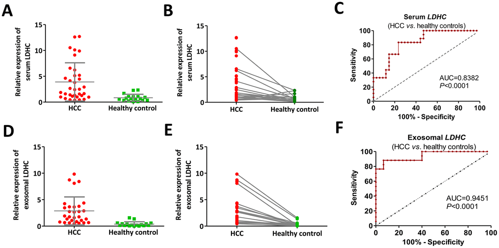 Cancer-specific pattern of serum and exosomal LDHC expressions in early-stage HCC determined its diagnostic implication. (A, B) Serum LDHC mRNA levels were significantly elevated in early-stage HCC serum samples compared with healthy individuals. (C) The ROC curve of serum LDHC mRNA for the identification of early-stage HCC. (D, E) Expressions of serum exosomal LDHC were elevated in early-stage HCC cases. (F) The ROC curve of serum exosomal LDHC in the diagnosis of early-stage HCC.