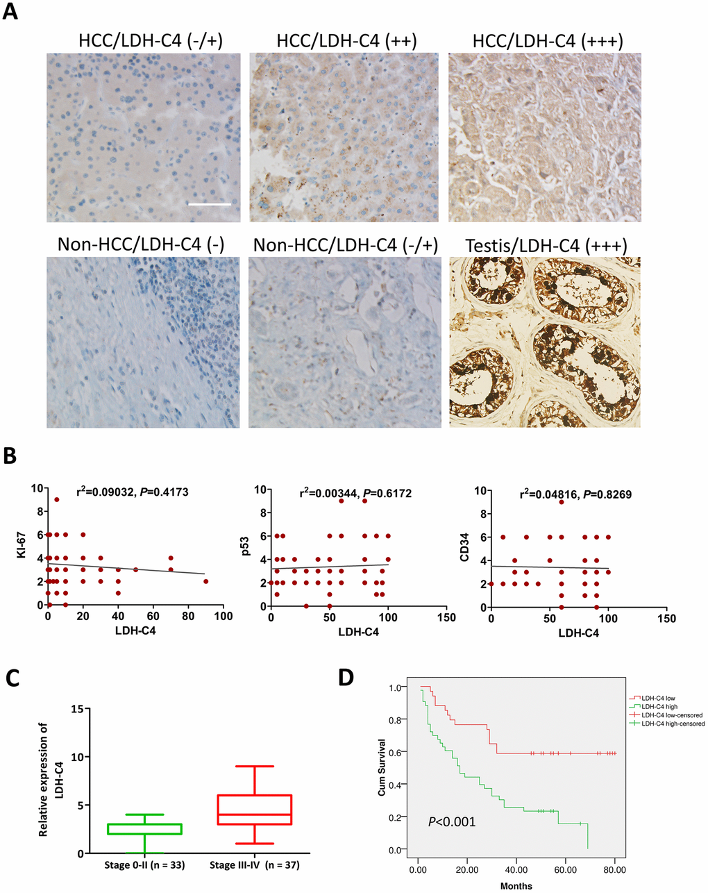 LDH-C4 expressions in HCC tissues using IHC analysis. (A) LDH-C4 levels were higher in HCC cancerous tissues than those in noncancerous tissues, and testis tissues were utilized as LDH-C4 positive controls (×200). (B) LDH-C4 levels were not significantly correlated with KI-67, p53 and CD34 expressions in HCC tissues. (C) LDH-C4 levels (rating scores) were higher in stage 0-II HCC patients than those in stage III-IV HCC patients. (D) The Kaplan-Meier analysis showed that LDH-C4 was negatively correlated with the prognosis of HCC patients, and higher levels of LDH-C4 implied worse prognosis.