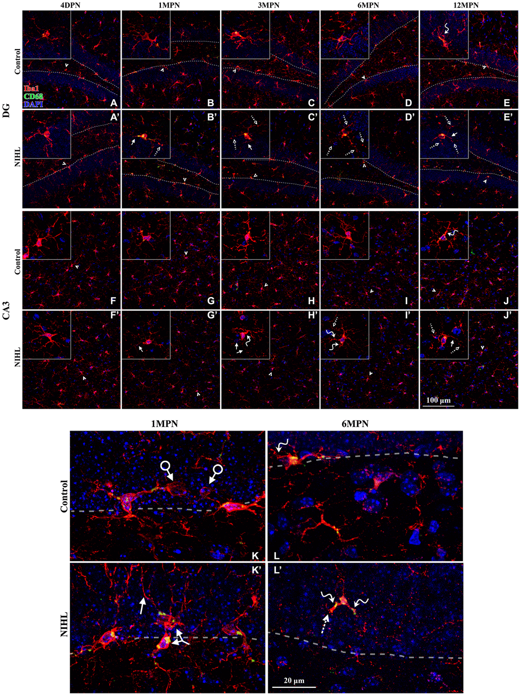 Microglial deterioration in the hippocampus associated with normal aging is aggravated by NIHL. (A–J’) Representative z-projection images of cells labeled with Iba1 (red), CD68 (green), and DAPI (blue) in the DG (A–E’) and CA3 (F–J’). Dotted lines in (A–E’) depict the SGZ (region between the granule cell layer and hilus). Iba1+ cells signified by arrowheads are magnified in the corresponding inserts. Scale bar equals 100 μm. (K–L’) Representative magnified images of Iba1-labeled cells in the DG from both groups at 1 MPN (K–K’) and 6 MPN (L–L’). Dotted lines depict the SGZ. Dystrophic cells are readily distinguished from ramified cells by degenerative changes in their cytoplasmic structure, such as deramified/atrophic cells (solid line arrows in B’, C’, E’, J’, H’, J’, and K’), fragmented or unusually tortuous processes (wavy arrows in E, J, H’, I’, L, and L’), and the formation of fragmented or beaded processes (dotted arrows in B’, C’, D’, E’, I’, J’, and L’). Arrows with circles in (K) point to microglial phagocytic pouches, a special modification of the microglial process involved in removing apoptotic cells from the adult SGZ neurogenic niche [27, 28]. The two-headed arrow in (K’) points to two abnormally aggregated microglial cells. Scale bar equals 20 μm.