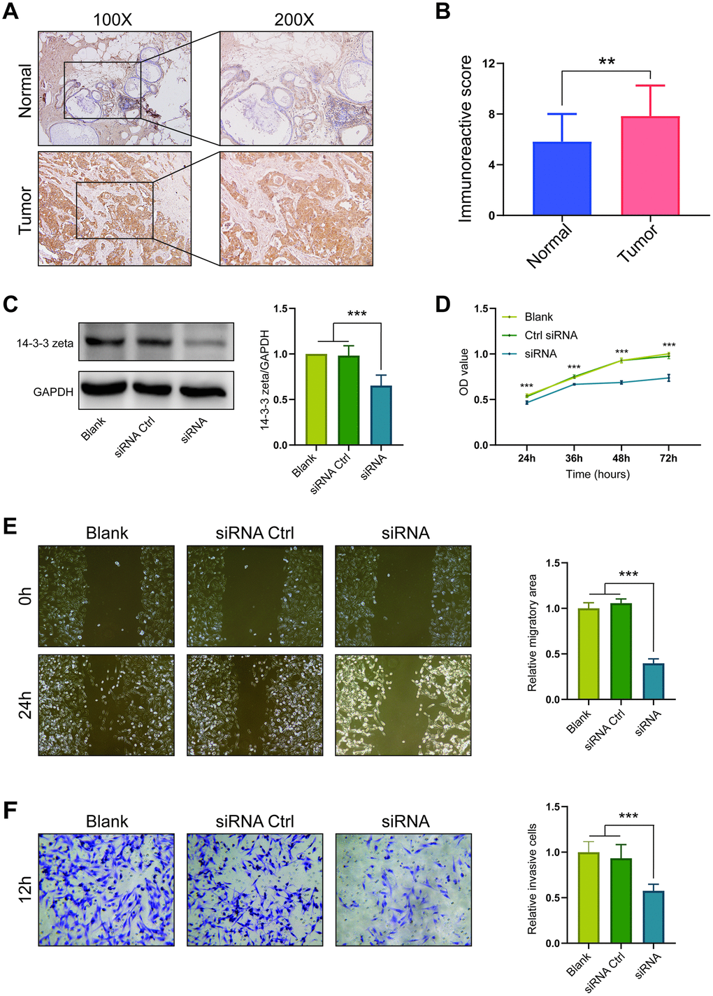 Expression and oncogenic role of 14-3-3 zeta in BrCa. (A) Representative microphotographs revealing 14-3-3 zeta expression in BrCa and normal tissues using IHC staining. (B) T-test analysis of 14-3-3 zeta expression in BrCa and normal tissues. (C) 14-3-3 zeta protein downregulation after transfection of 14-3-3 zeta-specific siRNA. The 14-3-3 zeta-specific siRNA suppressed the (D) viability, (E) migration, and (F) invasion of MDA-MB-231 cells.