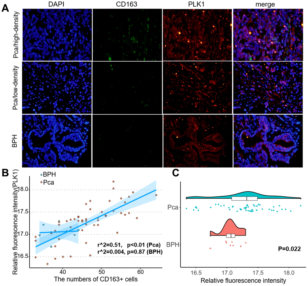 PLK1 expression correlated positively with M2 macrophage infiltration. (A) Fluorescence imaging of human prostate cancer and adjacent noncancerous tissues with FITC-labeled CD163 and Cy3-labeled PLK1. Most green fluorescent signals were observed on the cytomembrane, while red fluorescent signals were primarily located in the cytoplasm in prostate tissue. (B) Numbers of green fluorescent cells and red fluorescence integral optical density were positively correlated in prostate cancer samples (r2=0.51, pC) PLK1 staining was more intense in prostate cancer tissues than in non-cancerous prostate tissues.