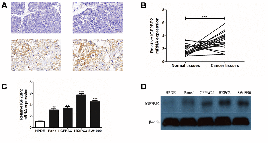 Experimental validation of IGF2BP2 over-expression in PAAD tissue array and cell lines in vitro. (A) Immunohistochemistry staining (IHC) for a pair of PAAD tissues and their adjacent normal tissues for IGF2BP2 protein. The upper part of the figure showed normal pancreas tissues and the lower part showed the corresponding PAAD tissue staining. The two pictures in left panel were magnified 200 times (200x), and the right panel, 400 times (400x). (B) Quantitative real-time PCR (qRT-PCR) for mRNA expression of IGF2BP2 in 20 pairs of PAAD cells and their corresponding normal pancreatic cells. (C) qRT-PCR of IGF2BP2 for 4 PAAD cell lines and one normal pancreatic ductal epithelial cell line (HPDE) in vitro. (D) Western Blotting (WB) showed the protein level of IGF2BP2 in 4 PAAD cell lines and HPDE cell line in vitro (**, P 