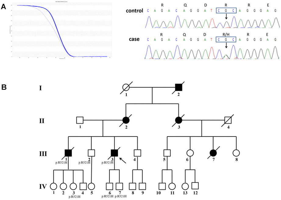 The pedigree with FUS mutation p. R521H. (A) Results of HRM analysis and direct sequencing of patients. (B) Pedigree of the family. An arrowhead indicates the proband. Patients III2, IV3, IV6, and IV7 shared the same mutation, but they did not appear as ALS phenotypes until now.