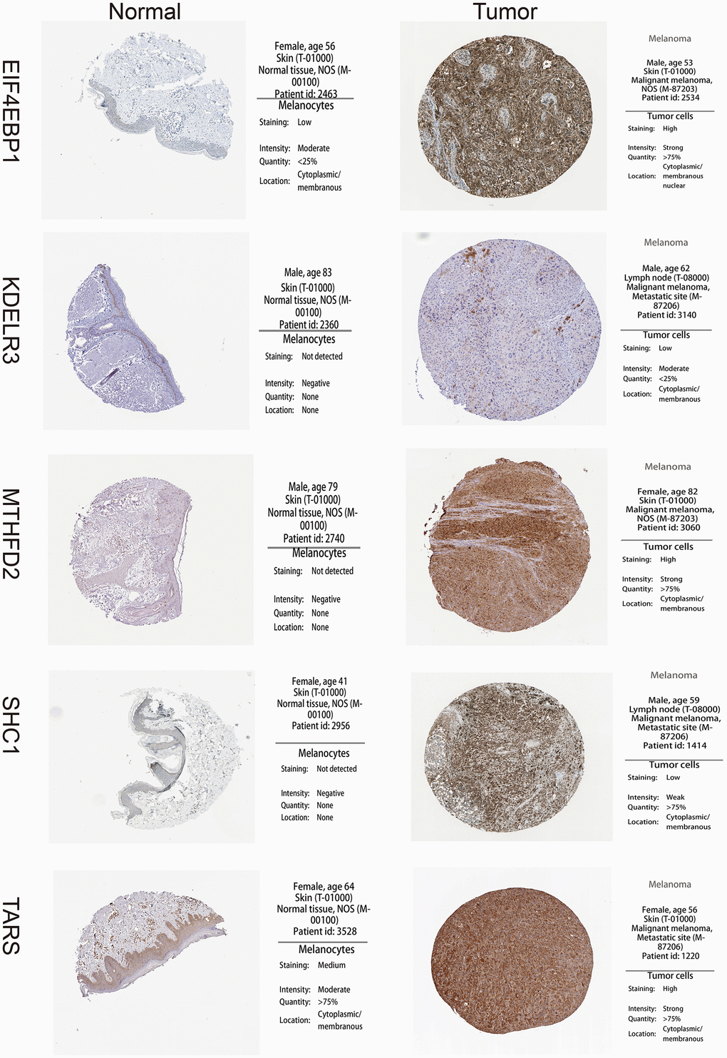 High expression of 5 unfolded protein response related genes (UPRRGs) by immunohistochemistry in The Human Protein Atlas website.